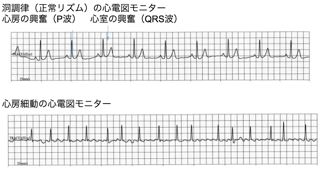 動 症状 細 心房 心房細動の原因と仕組み｜教えて！心房細動.com