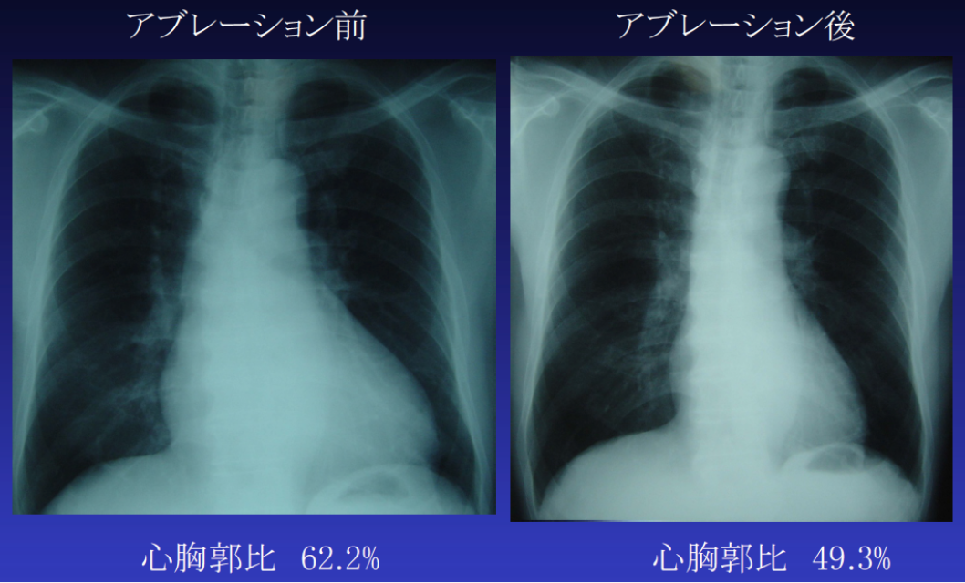 心房 細 動 手術