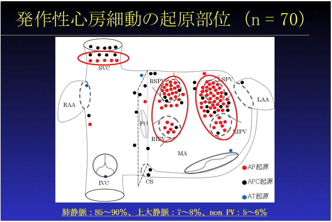 心房細動の誘発方法 | 不整脈といえば「東京ハートリズムクリニック」