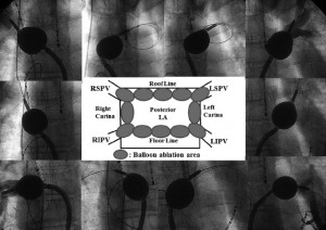 20160620_ホットバルーンアブレーション