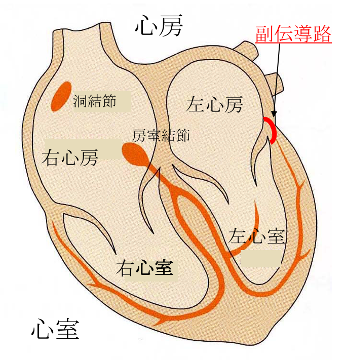 副伝導路症候群の発症メカニズム 心房と心室の間に通る副伝導路