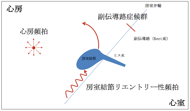 発作性上室性頻拍症 3つのメカニズム解説図