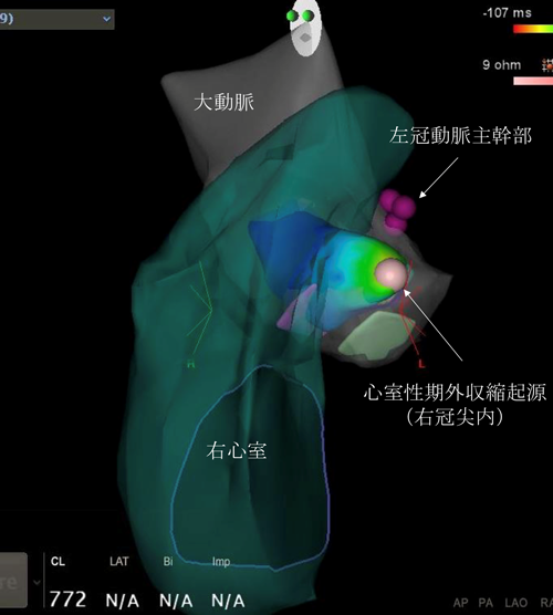 心室性期外収縮の発生源（起源）である右冠尖が映った心臓３次元画像（カルト像）
