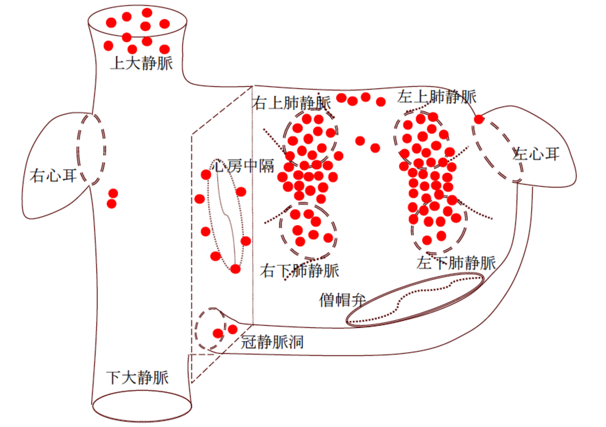 発作性心房細動とともに生きる