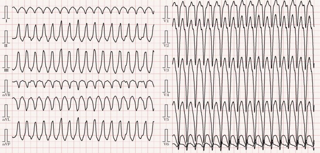 心室頻拍の心電図資料画像